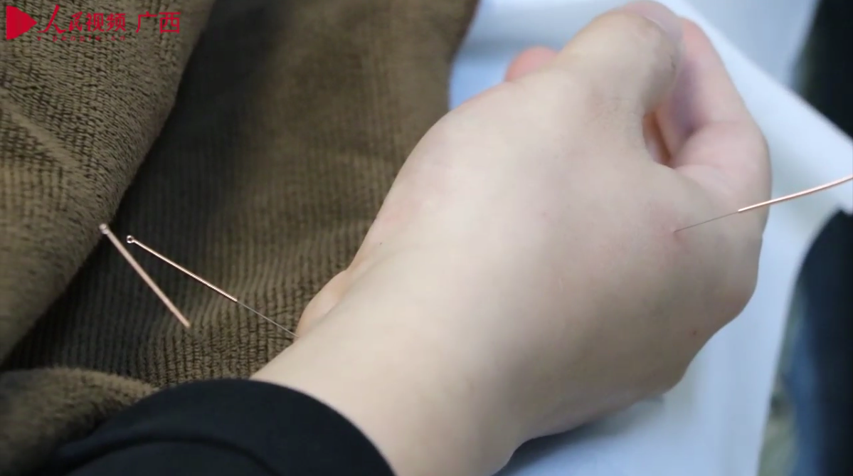 國壯體驗日：冠軍針灸手法，健康“針”給力